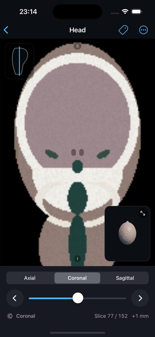 Head shown as a coronal CT slice with a locator and 3D preview