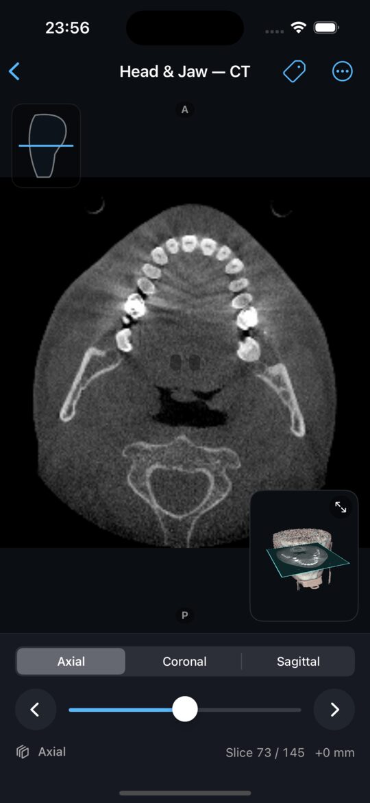 A real CT axial slice through the torso
